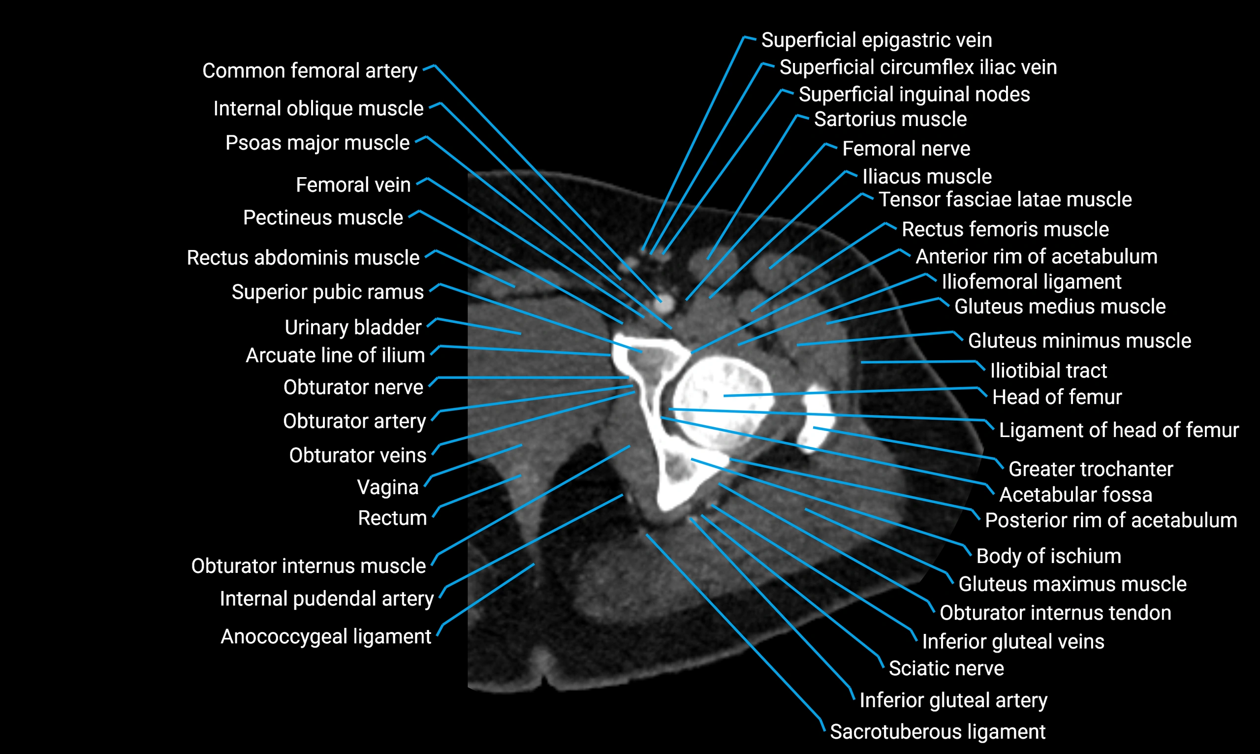 CT lower limb axial cross sectional anatomy labelled image 8 (1).webp